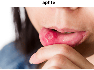 Traiter naturellement les aphtes avec les huiles essentielles